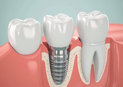 a 3D illustration of a dental implant in the jawbone