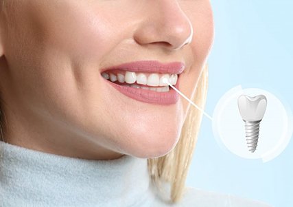 a woman smiling with a dental implant