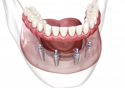 a 3D illustration of All-On-4 dental implants