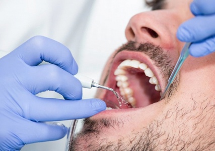 a man getting a dental cleaning