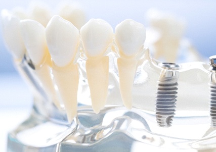 Model of dental implant posts