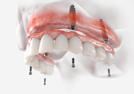 Fixed implant denture for upper dental arch