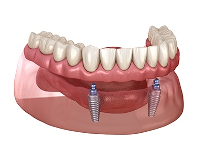 Illustration of ball-retained removable implant denture