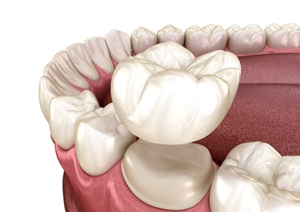 Digital image of a metal-free dental crown being placed over a natural tooth on the lower arch of the mouth